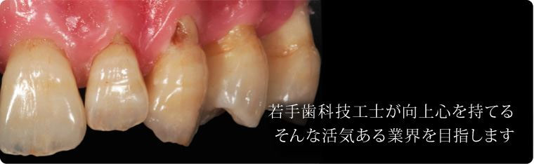 歯科技工臨床症例４