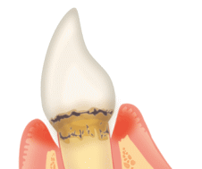 歯肉の退縮